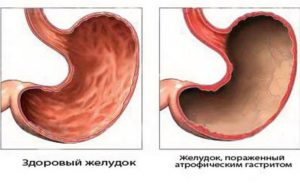 Что принимать при гэрб, имея атрофический гастрит