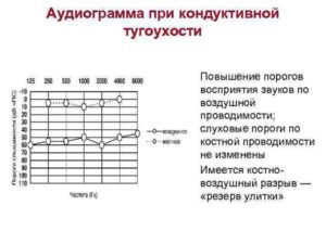 Временное улучшение слуха при нейросенсорной тугоухости