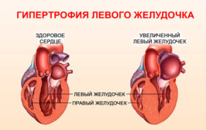 Что значит гиперкинез сердца?