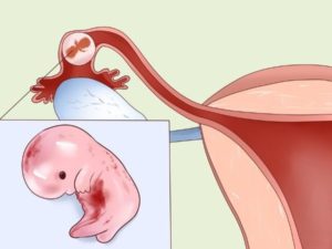 Внематочная беременность или гормональный сбой
