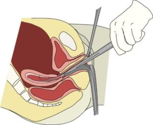 Вакуумная аспирация. Гиперплазия эндометрия