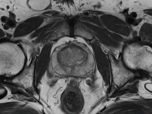 МРТ предстательной железы