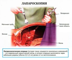 Месячные после лапароскопии маточной трубы