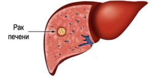 Диарея при раке печени