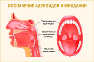 Увеличеные миндалины и храп