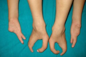 Врожденный дефект недоразвития четвертых пальцев ног