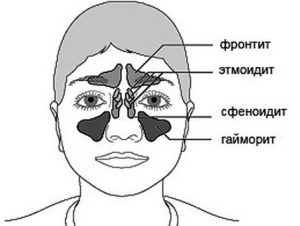 Двусторонний верхнечелюстной синусит, этмоидит, сфеноидит