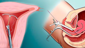 Внутриматочная спираль и боль внизу живота