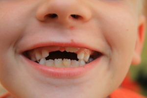 Чем можно заменить выпавший зуб?