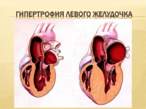 Что значит гиперкинез сердца?