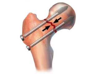 Металлоостеосинтез канюлированными винтами перелома шейки бедра