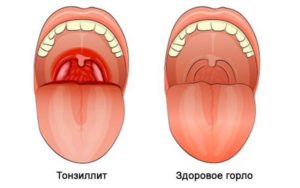 На языке постоянно налет и при простуде часто болит горло