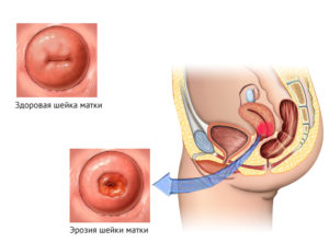 Мешает ли эрозия шейки матки забеременеть?