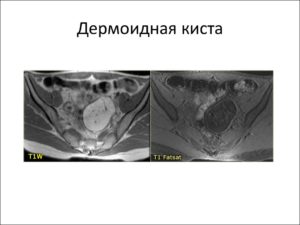 МРТ дермоидной кисты