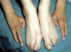 Врожденный дефект недоразвития четвертых пальцев ног