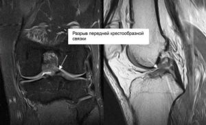 МР-признаки частичного повреждения передней крестообразной связки. Реактивный синовиит. Дегенеративн
