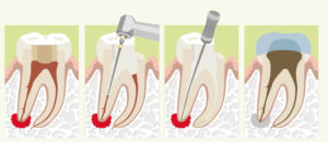 Можно оставить корень разрушенного зуба в десне на пару месяцев?