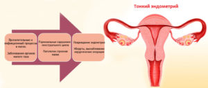 Возможно ли зачатие при тонком эндометрии