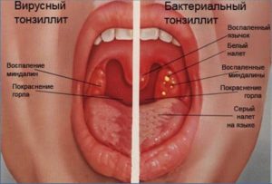 Долго не проходит краснота в горле, дужки