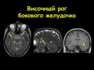 Дистанция затылочных рогов боковых желудочков