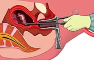 Мягкая матка после фарм аборта