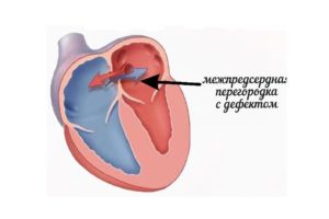 Дефект межпредсердной перегородки у новорожденного