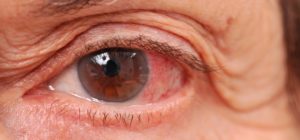 Возрастное слезотечение глаукома