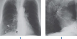 Эмфизема лёгких и диффузный пневмосклероз