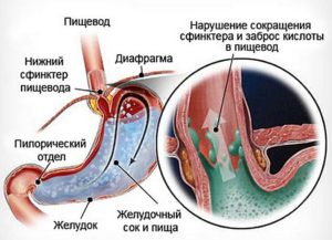 Дистальный рефлюкс-эзофагит