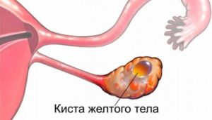 Набухла грудь при кисте жёлтого тела