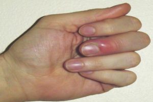 Воспаление пальца и болит рука