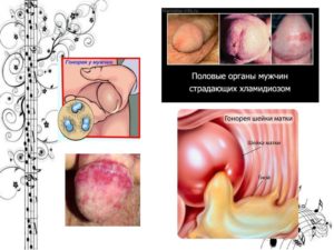 Можно ли целоваться при хламидиозе