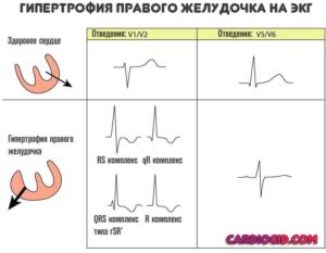 Возможна гипертрофия правого желудочка. Пульс 144