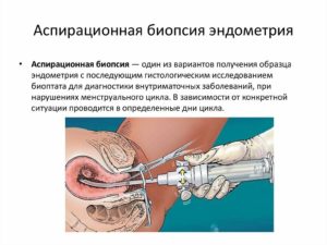 Вакуумная аспирация. Гиперплазия эндометрия