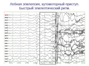 Эпилепсия без изменений на ээг