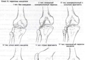 Мыщелок большеберцовой кости перелом без смещения