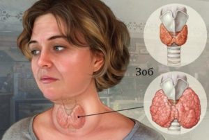 Диффузно узловые изменения щитовидной железы
