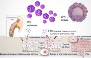 ВПЧ 16, 18 прижигание