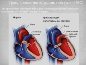 Диаметр легочной артерии меньше диаметра аорты