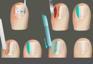 Вросший ноготь лечение