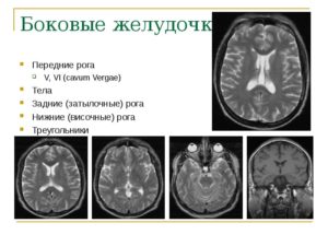 Дистанция затылочных рогов боковых желудочков