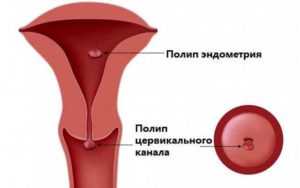 Миома матки и патология эндометрия