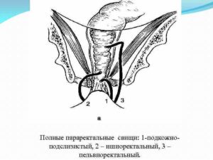 Врожденный параректальный свищ