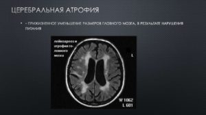 Что делать при атрофии мозга 1 степени