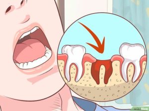 Чем можно полоскать рот после удаления зуба мудрости