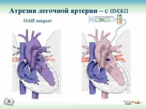 ВПС ДМЖП, ТМС, гипоплазия Легочной артерии
