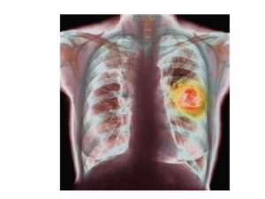 Может ли рентген спровоцировать развие онкологии