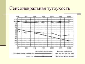 Двусторонняя сенсоневральная тугоухость