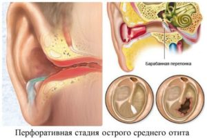 Выделения из уха при отите