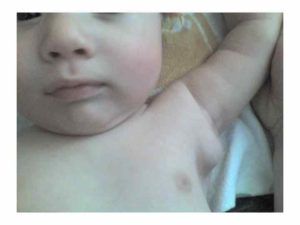 Воспаление подмышечного лимфоузла у ребенка